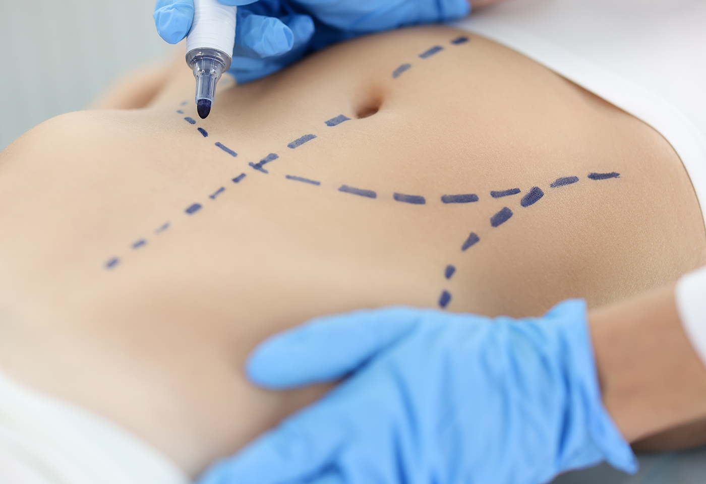 Doctor plastic surgeon drawing preoperative markings on skin of patient abdomen closeup.